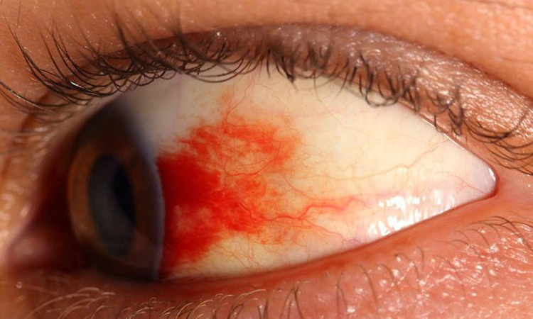 ডায়াবেটিসজনিত চোখের সমস্যা